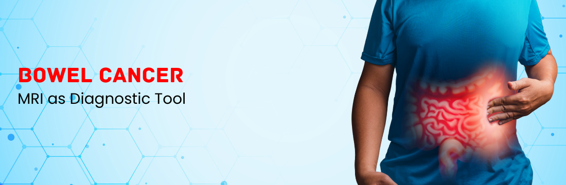 Bowel Cancer and MRI as Diagnostic Tool